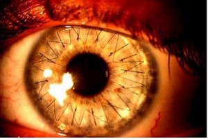 Photo showing an eye that underwent cornea transplant. Very thin sutures that are used to stitch the donor cornea can be seen. 