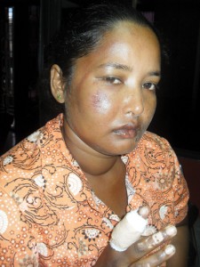 Nandranie Bachu displays her battered face and burnt fingers.  