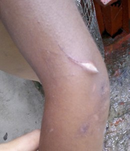 The five-year-old displays a cut she received on her arm from the beating.