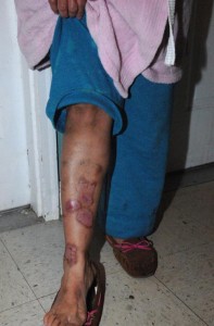 Daisy Machuea, 54, reveals the bruises she said she obtained in the attack. 