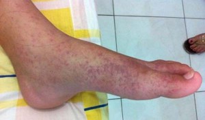The CHIKV virus is known to cause a number of symptoms including a rash