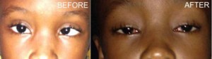 An eight- year-old patient, before and after her surgery by the visiting team of Trinidadian doctors at the GPHC.