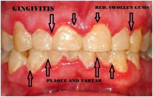 gingivitis