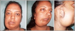 Shivanie Naryan, as these photos bear out, still requires corrective surgeries.
