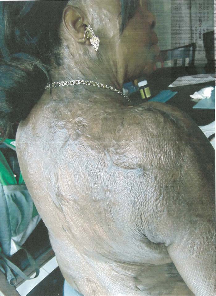 Abiola Clarke-Wilson displaying some of the scars on her body.