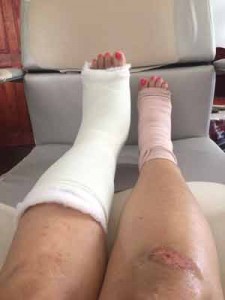 Bibi Singh suffered a broken foot after stumbling on the elevated structure.