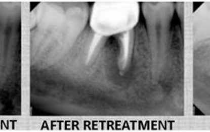 Dental Health: Root Canal Failures