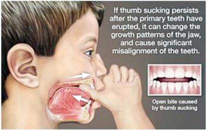 DENTAL HEALTH: Thumb Sucking