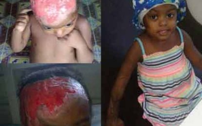 Father pleads for overseas help for burnt three-year-old daughter