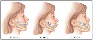 malocclusion