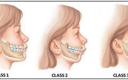 Dental Health…MALOCCLUSIONS – CROOKED TEETH