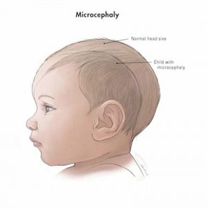 A baby with microcephaly