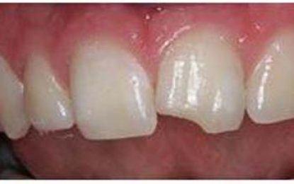 DENTAL HEALTH…CHIPPED TOOTH