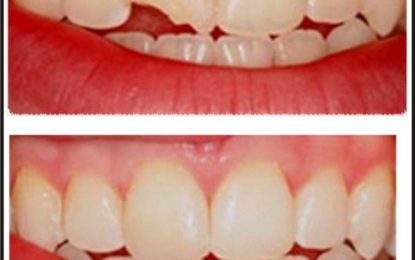 DENTAL HEalth…COMPOSITE FILLINGS