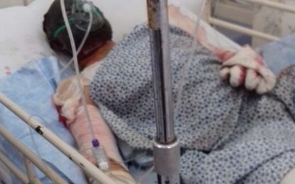 Corentyne man dies days after kerosene lamp explodes