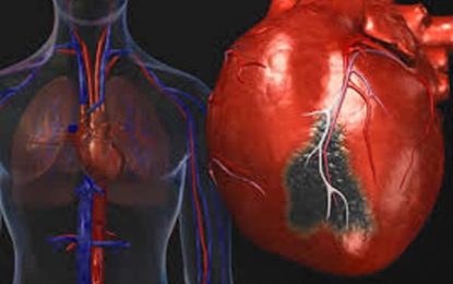 Report: Guyana, T&T lead Americas in heart-related deaths