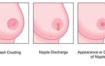 Cervical cancer overtakes breast cancer as leading cancer in Guyana