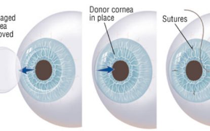 Subraj Foundation collaborates with GPHC to ship corneas for transplant surgery
