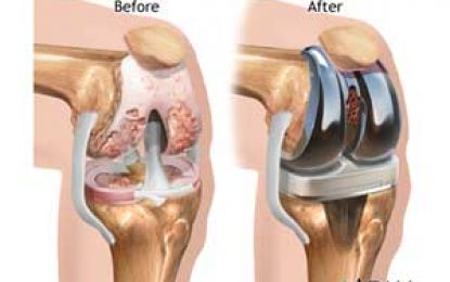 Knee replacement: Taking away the pains