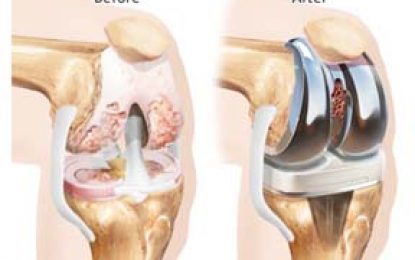 Knee replacement: Taking away the pains