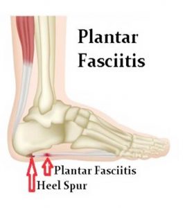 excruciating heel pain