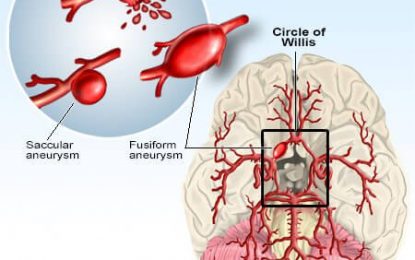 A brain aneurysm- “the ticking time bomb”