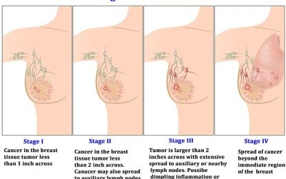 100 percent survivability rate possible for breast cancer victims