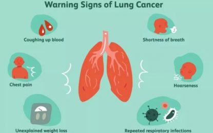 Most local lung cancer cases diagnosed very late – Thoracic Surgeon