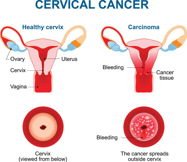World Health Organization (WHO) on X: Signs of #CervicalCancer