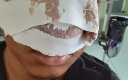 16-year-old still critical in hospital following Diwali chopping