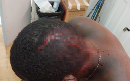 Music dispute leaves Essequibo man nursing chop wounds to head, face