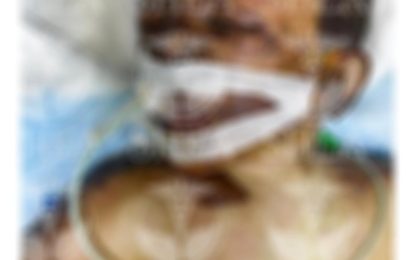 Severely burnt boy medevaced for urgent treatment overseas